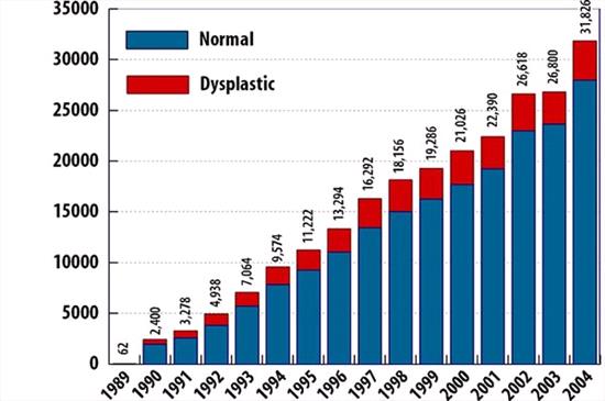 Normal versus Dysplastic Elbows, 1989 - 2004